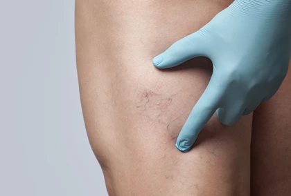 Thread, Red and Spider Veins