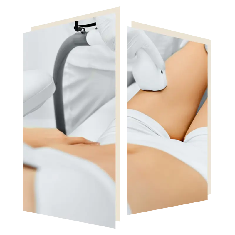 Laser Hair Removal for excessive hair at the door w4