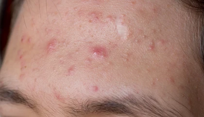 Acne