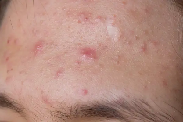 Acne