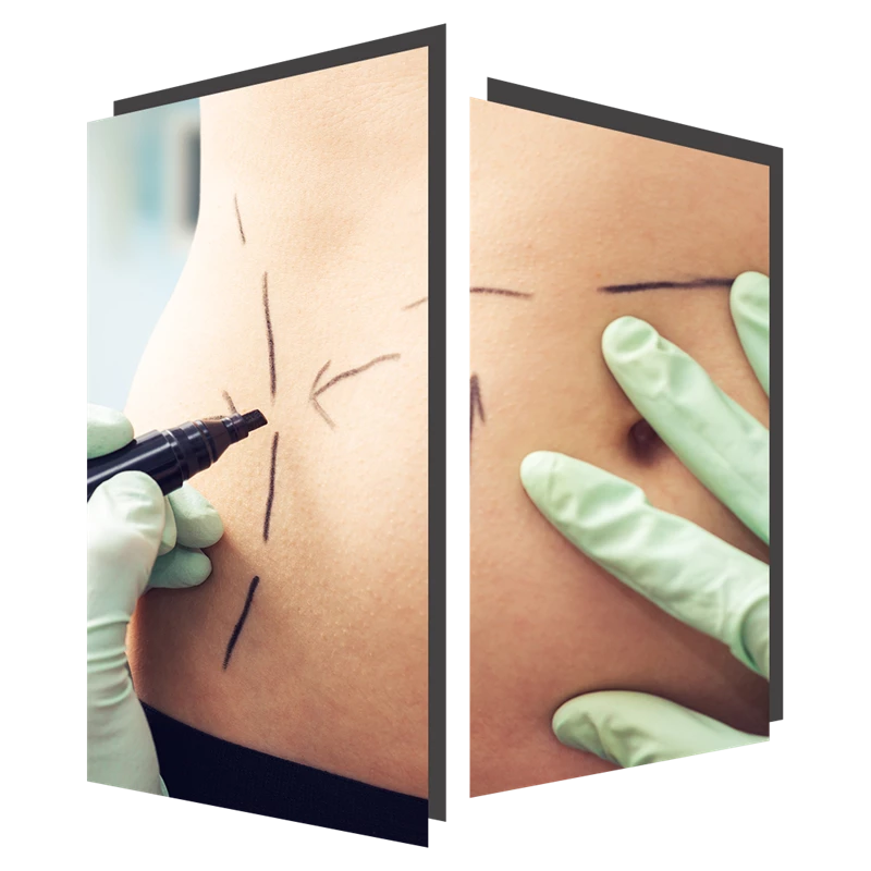 BodyTite treatable areas