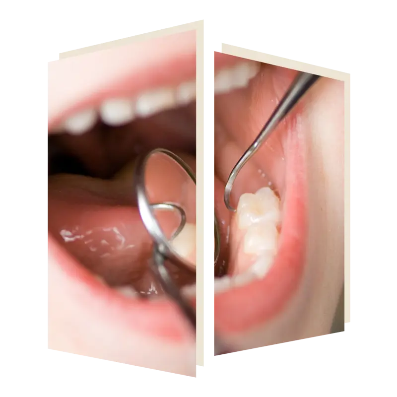 White Filling at the Dental Studio at The Door W4