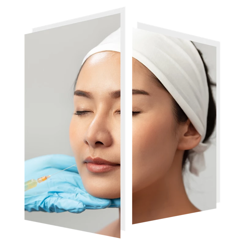 Dermal fillers at The Door W4 in Chiswick