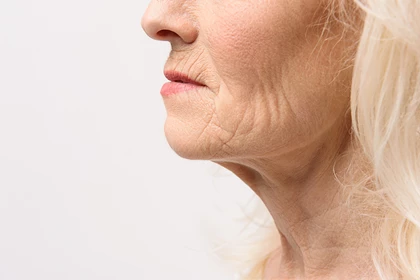 Loose Sagging Skin