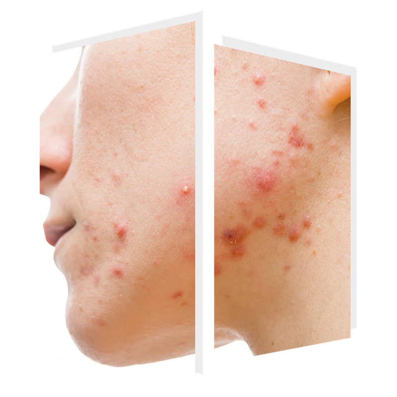 acne and acne scarring can be treated by ClearSkin laser at The Door W4