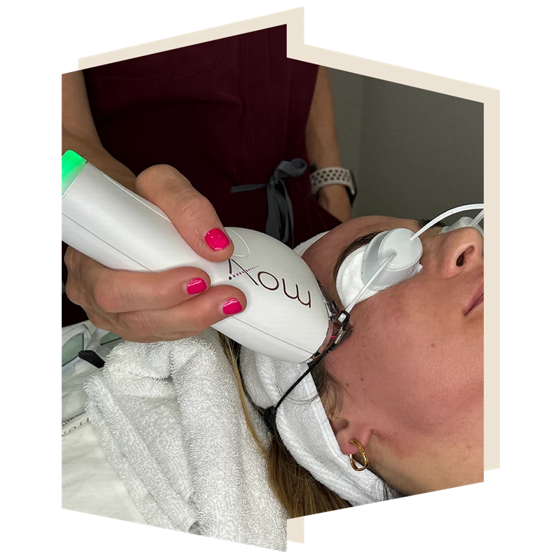 Moxi Laser by Sciton at The Door W4 for Skin Rejuvenation