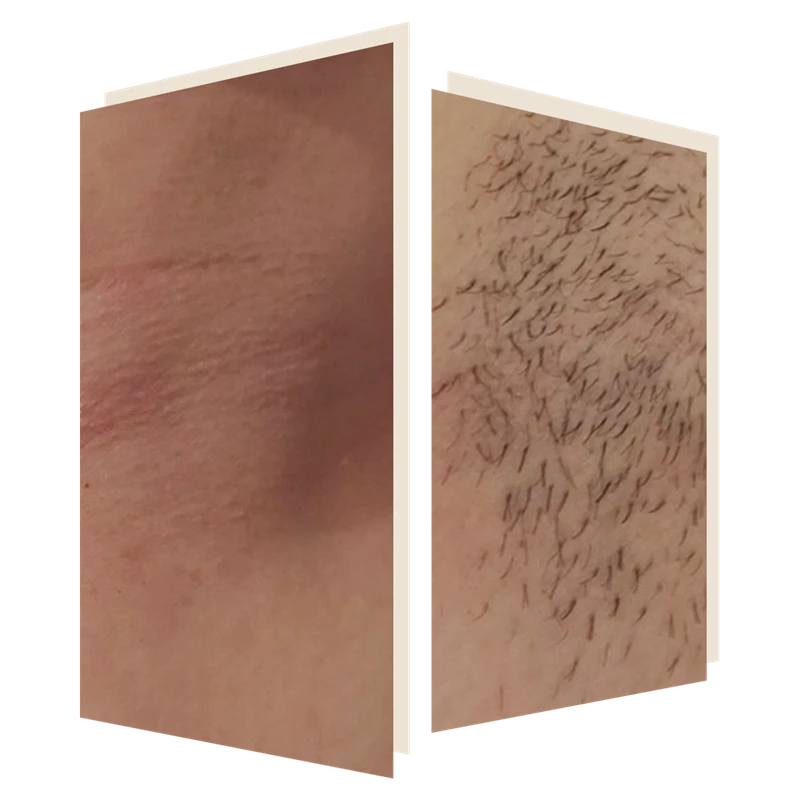 laser hair removal at the door w4