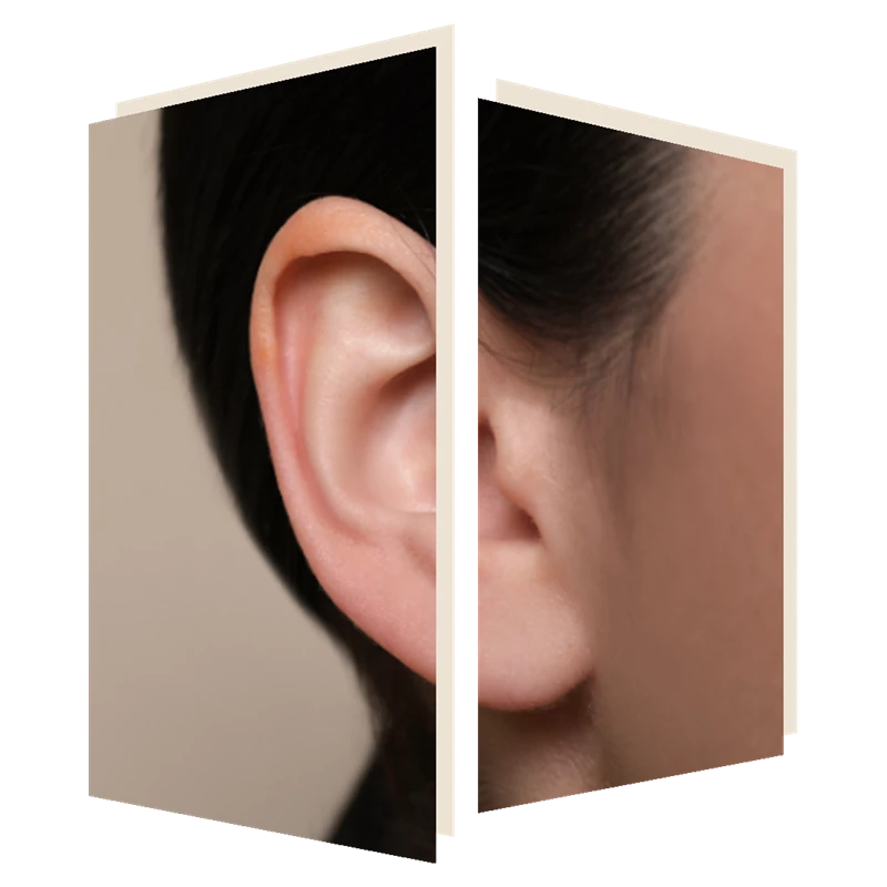 earlobe reconstruction