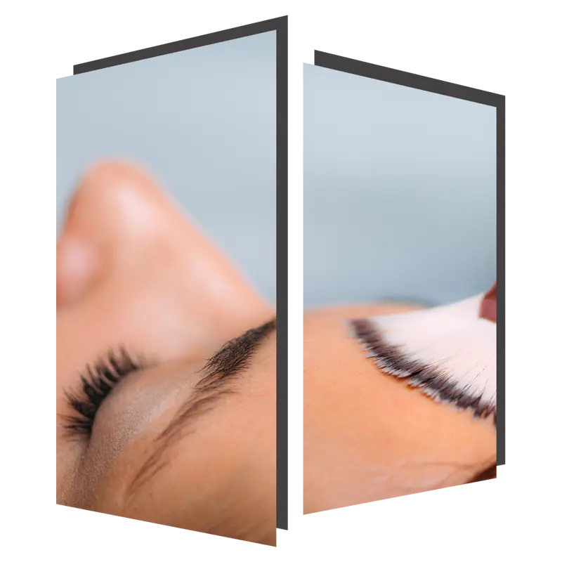 Chemical Peel