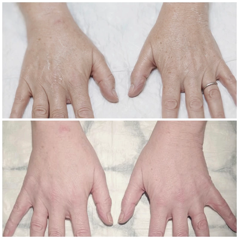 hand rejuvenation 4