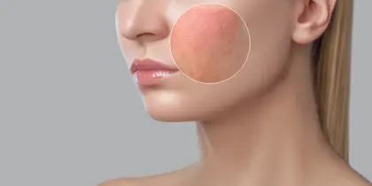 Dye Vascular Lesions (DYE VL)
